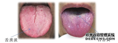 《老年男性良性前列腺增生症/下尿路症状药物治疗指南（2025版）》重磅发布 ——夏荔芪胶囊被纳入指南建议方案